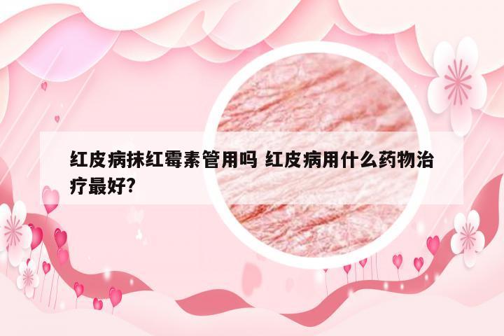 红皮病抹红霉素管用吗 红皮病用什么药物治疗最好?