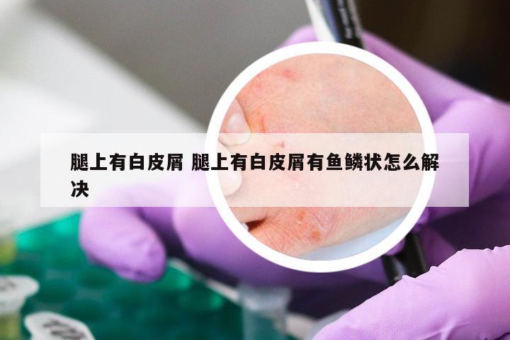 腿上有白皮屑 腿上有白皮屑有鱼鳞状怎么解决