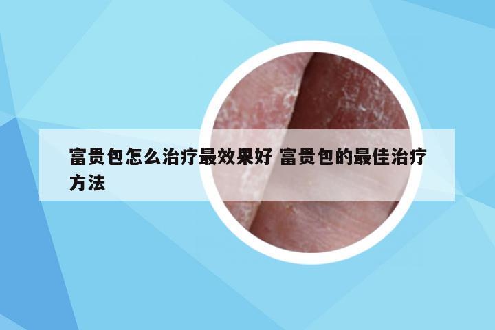 富贵包怎么治疗最效果好 富贵包的最佳治疗方法