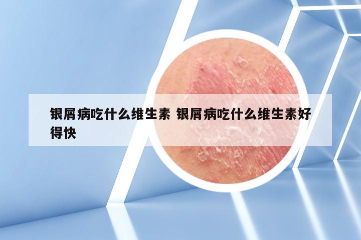 银屑病吃什么维生素 银屑病吃什么维生素好得快