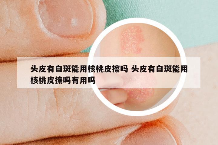 头皮有白斑能用核桃皮擦吗 头皮有白斑能用核桃皮擦吗有用吗