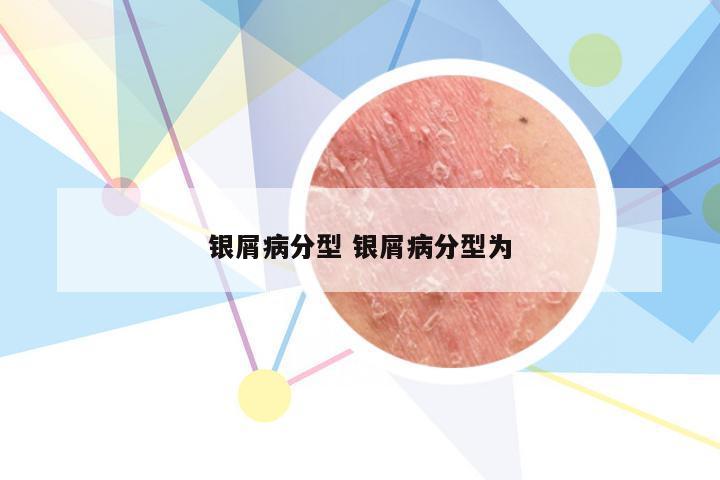 银屑病分型 银屑病分型为