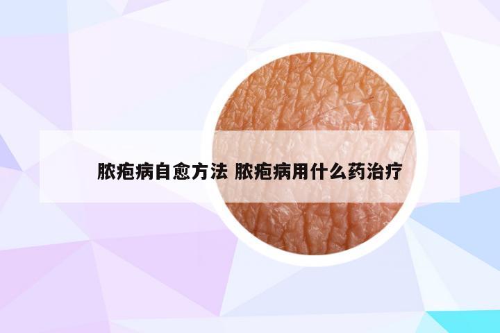 脓疱病自愈方法 脓疱病用什么药治疗