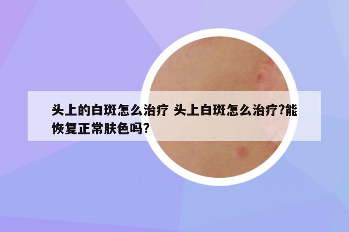 头上的白斑怎么治疗 头上白斑怎么治疗?能恢复正常肤色吗?