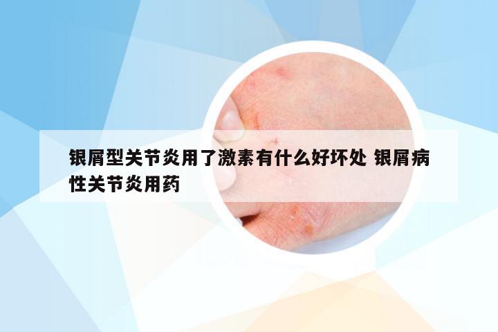 银屑型关节炎用了激素有什么好坏处 银屑病性关节炎用药