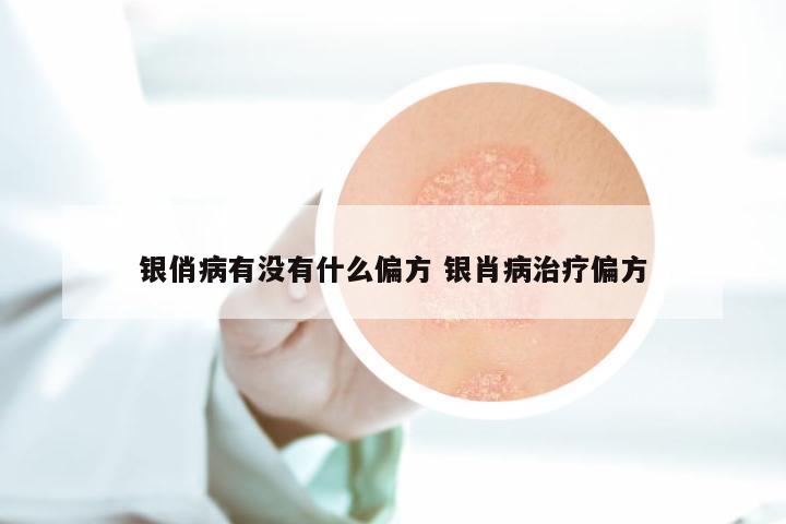 银俏病有没有什么偏方 银肖病治疗偏方