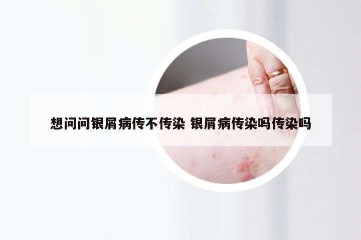 想问问银屑病传不传染 银屑病传染吗传染吗