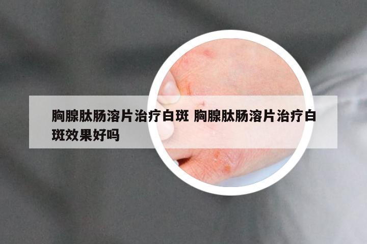 胸腺肽肠溶片治疗白斑 胸腺肽肠溶片治疗白斑效果好吗