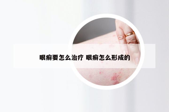 眼癣要怎么治疗 眼癣怎么形成的