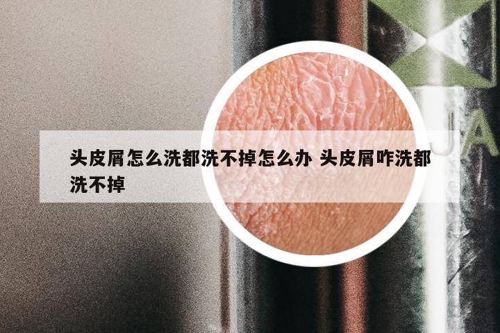 头皮屑怎么洗都洗不掉怎么办 头皮屑咋洗都洗不掉