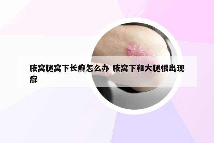 腋窝腿窝下长癣怎么办 腋窝下和大腿根出现癣