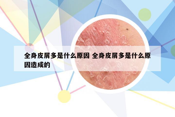 全身皮屑多是什么原因 全身皮屑多是什么原因造成的