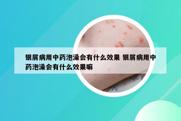 银屑病用中药泡澡会有什么效果 银屑病用中药泡澡会有什么效果嘛