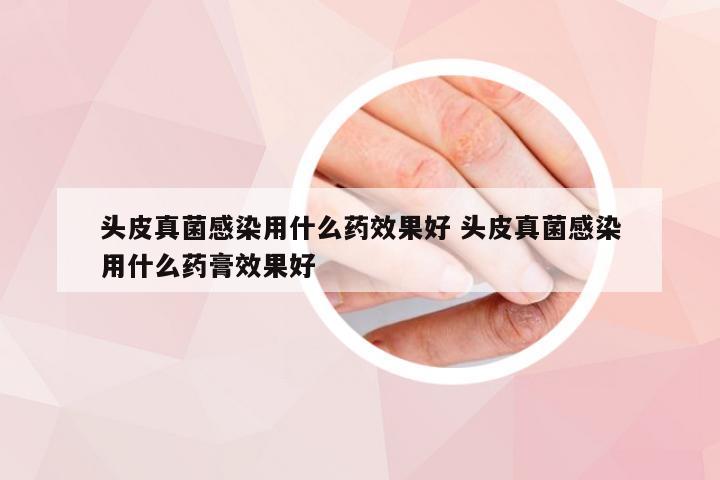 头皮真菌感染用什么药效果好 头皮真菌感染用什么药膏效果好