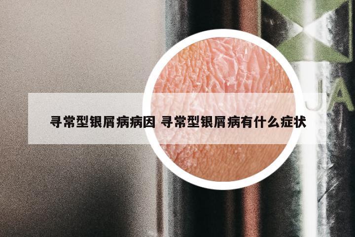 寻常型银屑病病因 寻常型银屑病有什么症状