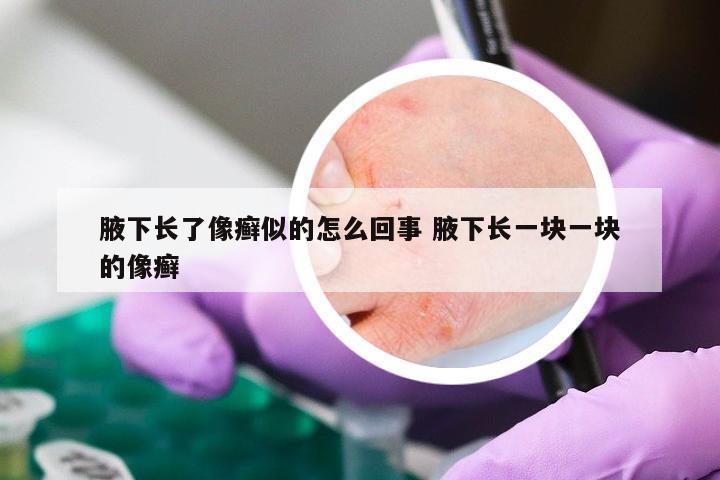 腋下长了像癣似的怎么回事 腋下长一块一块的像癣