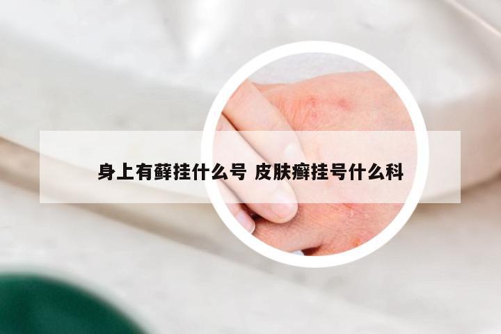 身上有藓挂什么号 皮肤癣挂号什么科