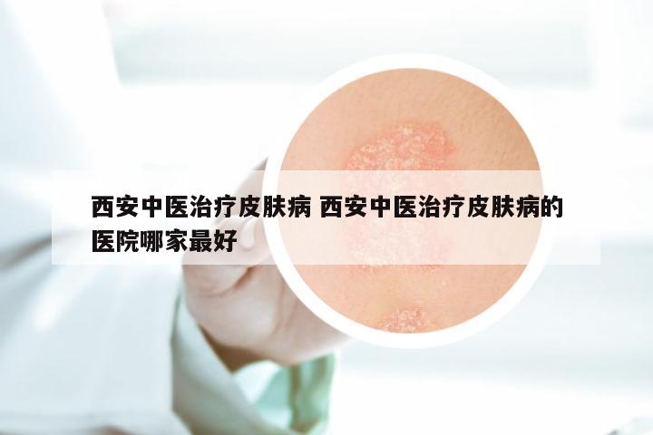 西安中医治疗皮肤病 西安中医治疗皮肤病的医院哪家最好