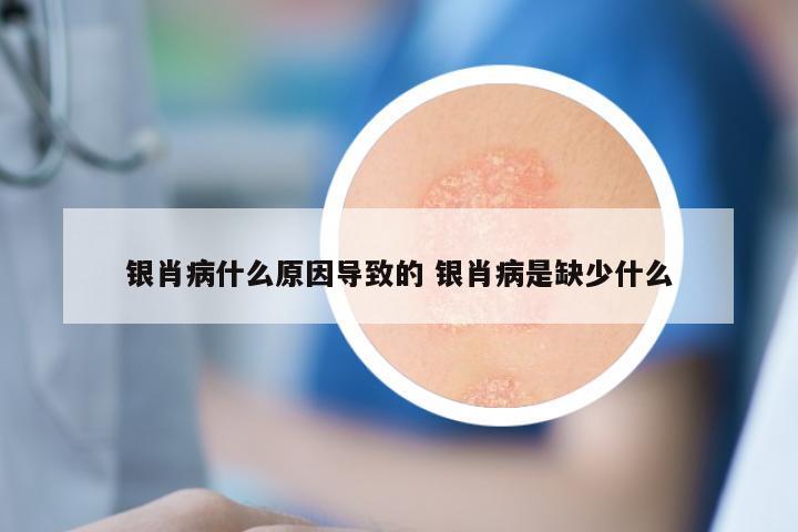 银肖病什么原因导致的 银肖病是缺少什么