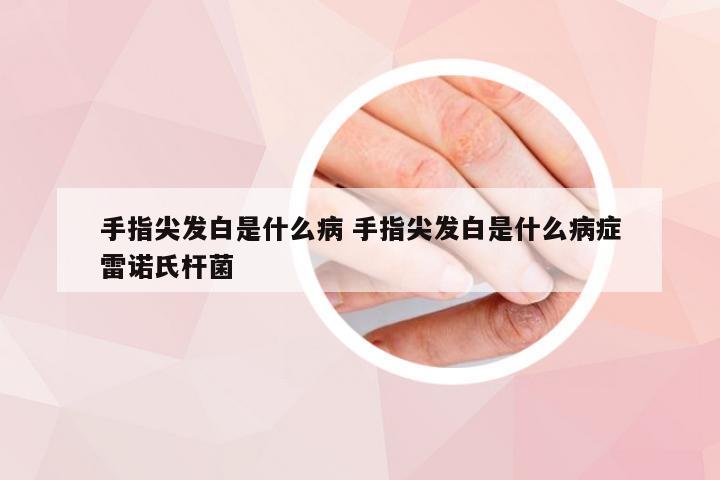 手指尖发白是什么病 手指尖发白是什么病症雷诺氏杆菌