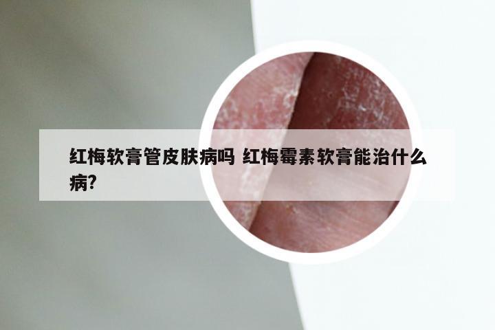 红梅软膏管皮肤病吗 红梅霉素软膏能治什么病?