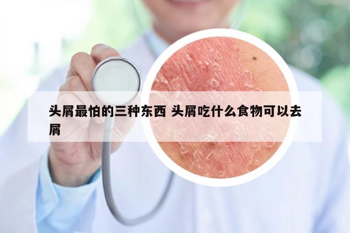 头屑最怕的三种东西 头屑吃什么食物可以去屑