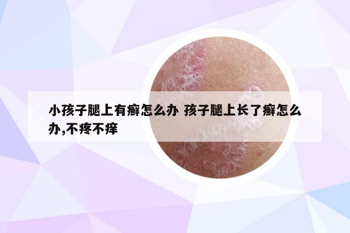 小孩子腿上有癣怎么办 孩子腿上长了癣怎么办,不疼不痒