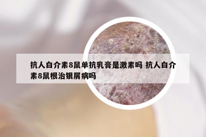 抗人白介素8鼠单抗乳膏是激素吗 抗人白介素8鼠根治银屑病吗