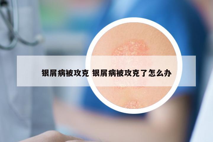 银屑病被攻克 银屑病被攻克了怎么办