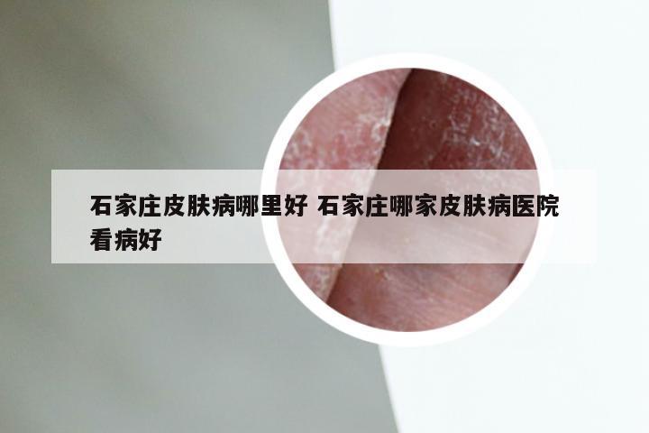 石家庄皮肤病哪里好 石家庄哪家皮肤病医院看病好