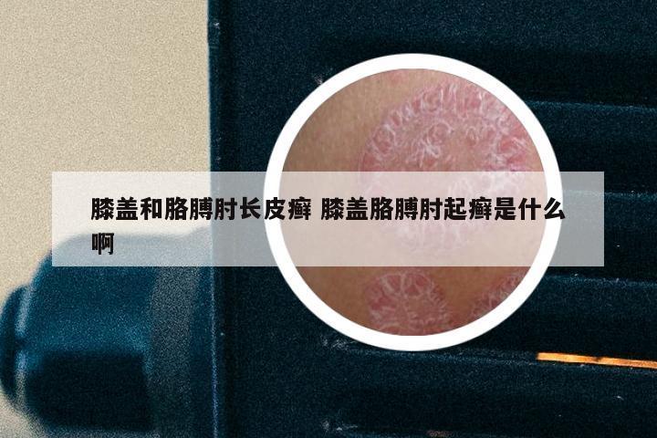 膝盖和胳膊肘长皮癣 膝盖胳膊肘起癣是什么啊