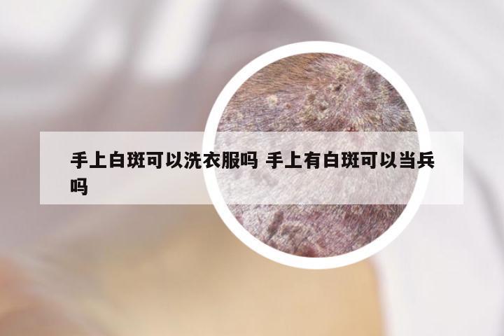 手上白斑可以洗衣服吗 手上有白斑可以当兵吗