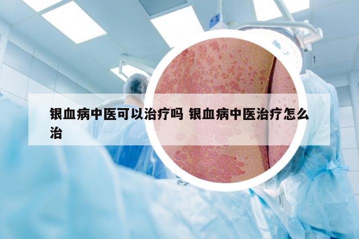 银血病中医可以治疗吗 银血病中医治疗怎么治