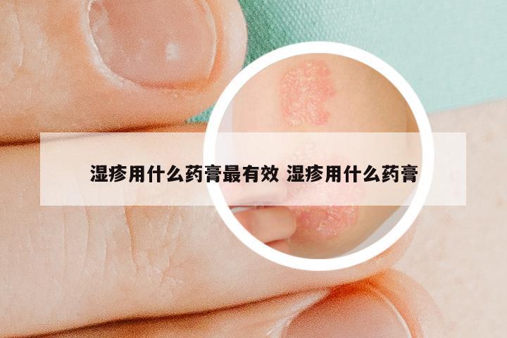 湿疹用什么药膏最有效 湿疹用什么药膏