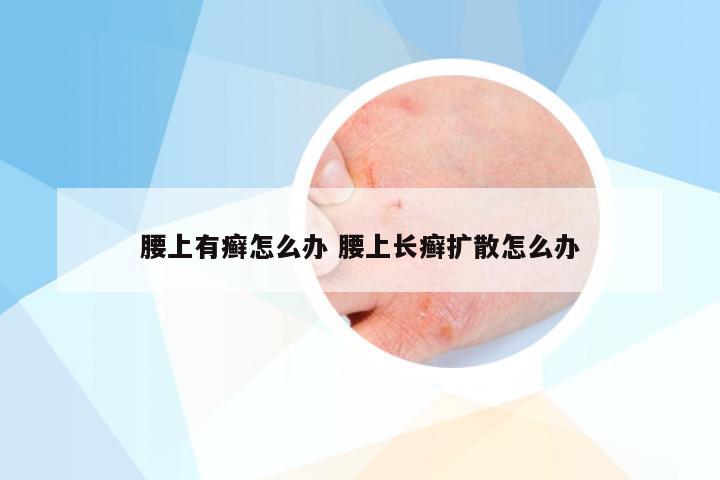 腰上有癣怎么办 腰上长癣扩散怎么办