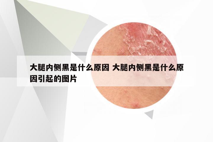 大腿内侧黑是什么原因 大腿内侧黑是什么原因引起的图片