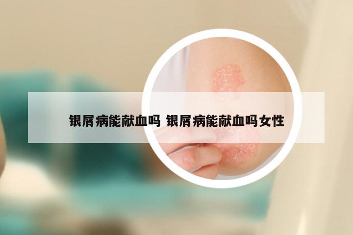 银屑病能献血吗 银屑病能献血吗女性