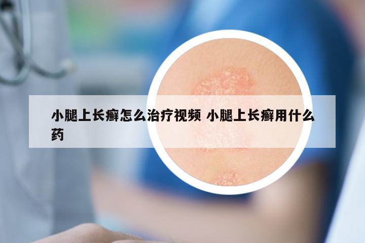 小腿上长癣怎么治疗视频 小腿上长癣用什么药