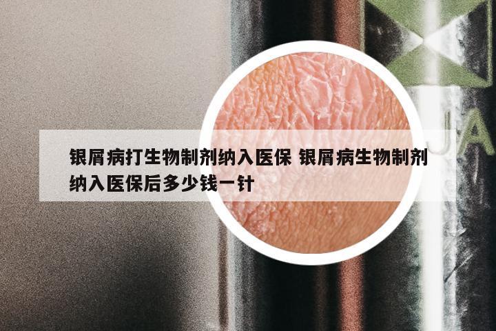 银屑病打生物制剂纳入医保 银屑病生物制剂纳入医保后多少钱一针