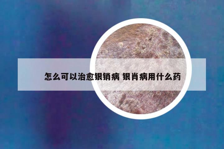 怎么可以治愈银销病 银肖病用什么药