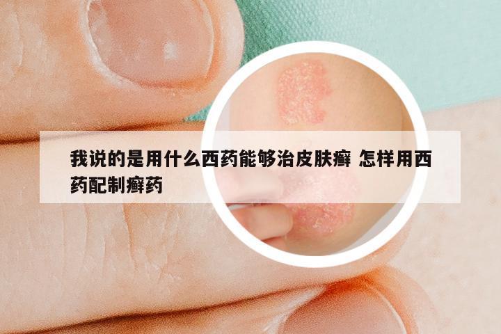 我说的是用什么西药能够治皮肤癣 怎样用西药配制癣药