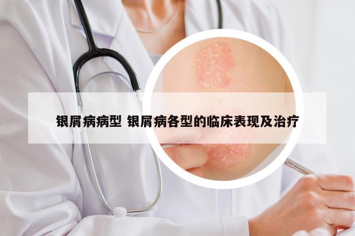 银屑病病型 银屑病各型的临床表现及治疗