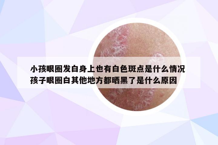 小孩眼圈发白身上也有白色斑点是什么情况 孩子眼圈白其他地方都晒黑了是什么原因