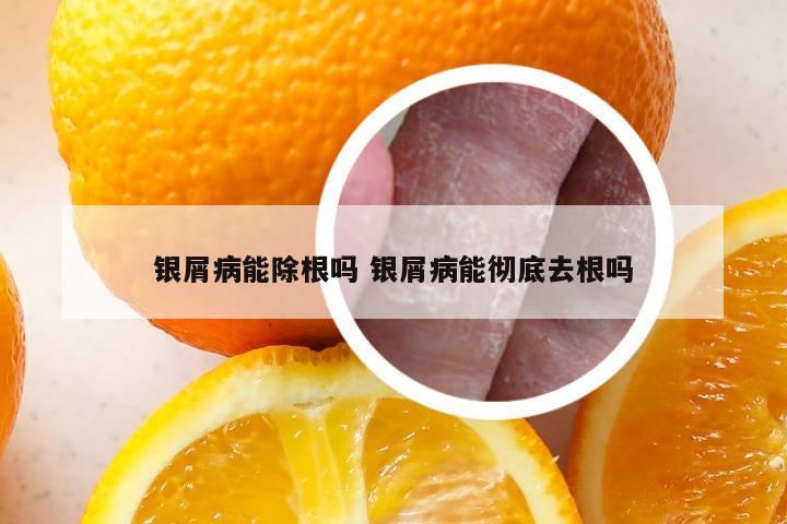 银屑病能除根吗 银屑病能彻底去根吗