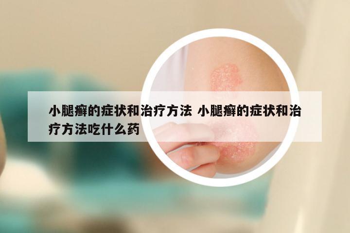 小腿癣的症状和治疗方法 小腿癣的症状和治疗方法吃什么药