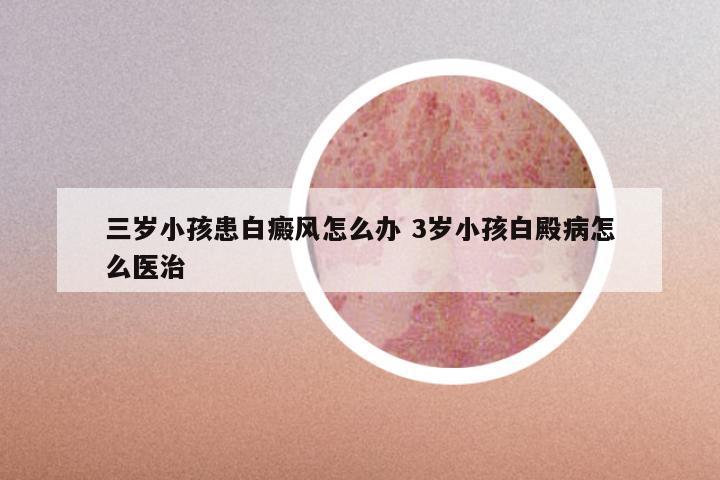 三岁小孩患白癜风怎么办 3岁小孩白殿病怎么医治