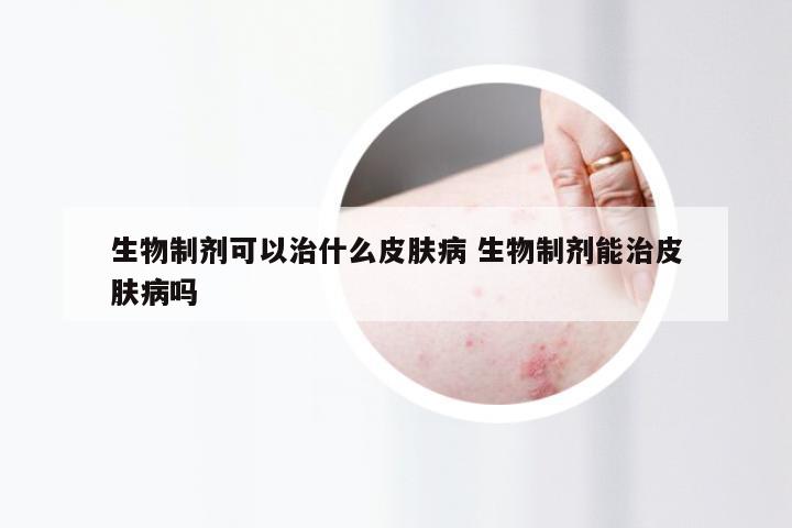 生物制剂可以治什么皮肤病 生物制剂能治皮肤病吗