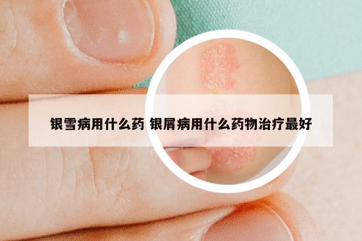 银雪病用什么药 银屑病用什么药物治疗最好