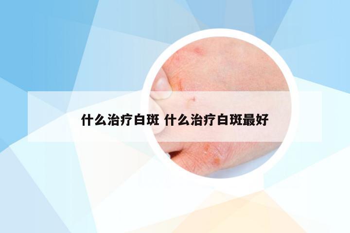 什么治疗白斑 什么治疗白斑最好