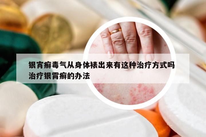 银宵癣毒气从身体裱出来有这种治疗方式吗 治疗银霄癣的办法